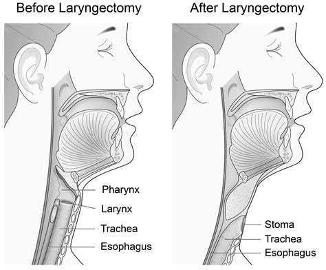 Total Laryngectomy .